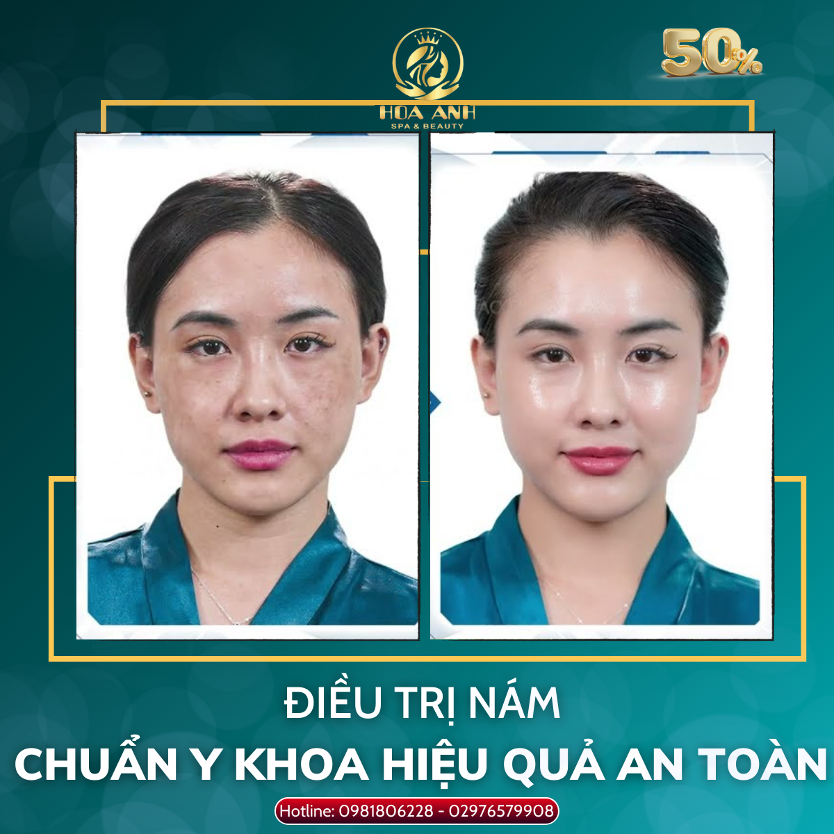 CÁCH TRỊ NÁM SÂU TẠI NHÀ GIÚP LÀM SÁNG DA